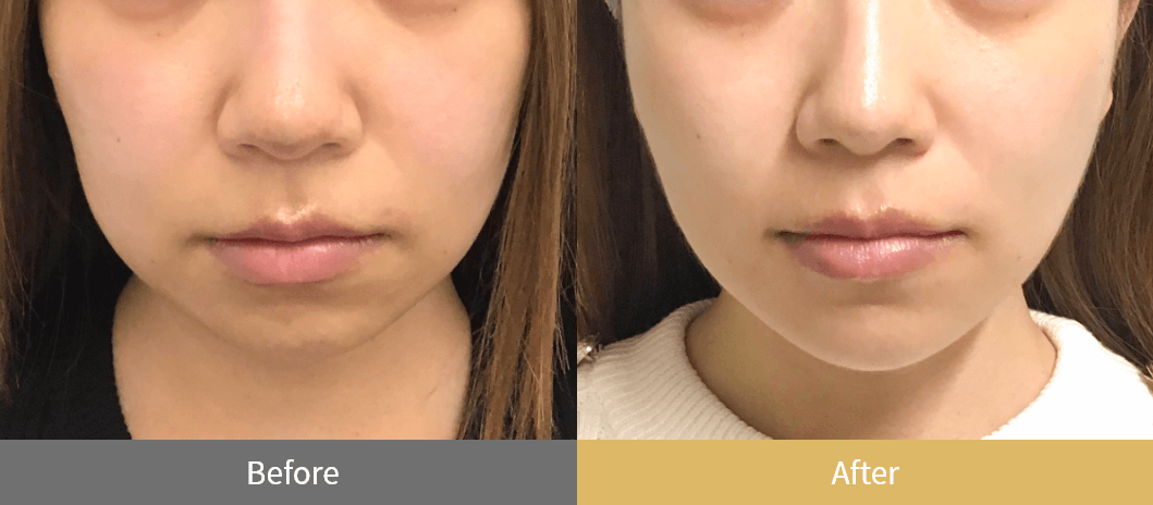 糸リフト（スレッドリフト）