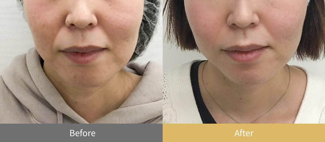 糸リフト（スレッドリフト）