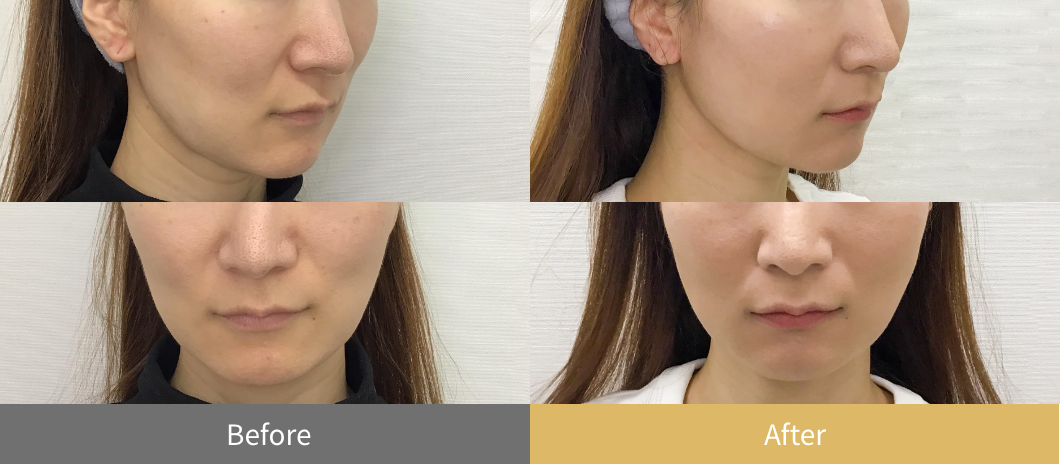 糸リフト（スレッドリフト）