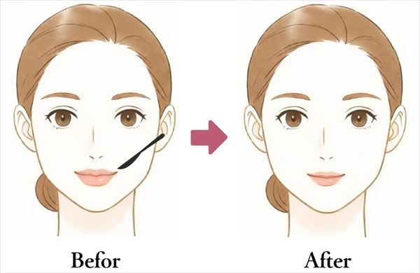 唇縮小(薄くする)手術のイメージ