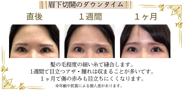 眉下切開（眉下リフト）が上手いクリニックの形成外科専門医によるダウンタイム経過写真。髪の毛程度の細い糸での精密な縫合から、1週間後の腫れ・アザの引き、1ヶ月後に傷跡が目立ちにくい仕上がりになるまでの実際の推移