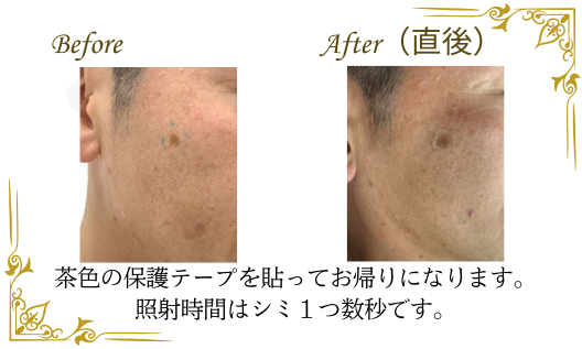 シミ取りレーザー後のテープ保護