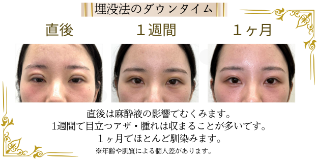 二重の埋没法のダウンタイムの時間経過