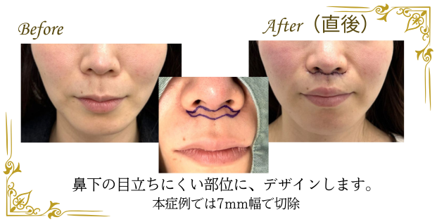 人中短縮(リップリフト)実際のデザイン