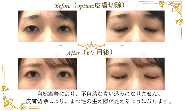 全切開による二重整形　ビフォアフター