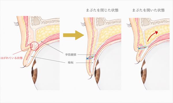 全切開により二重ができる仕組み