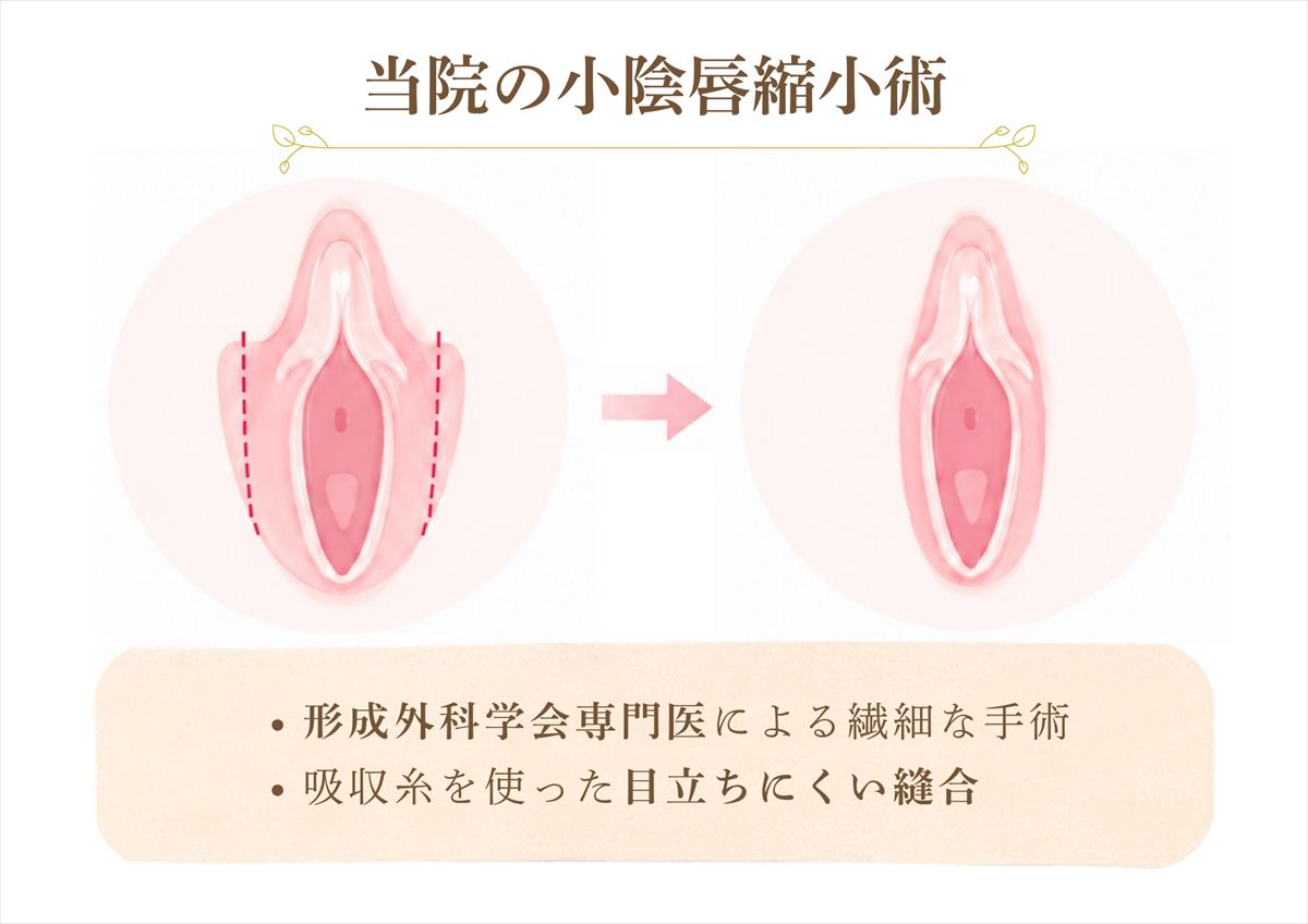 日本形成外科学会専門医による小陰唇縮小術・副皮切除の手術イメージ