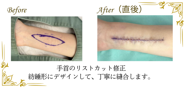 リストカット修正のビフォーアフター