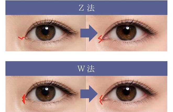 目頭切開　Z法とW法の２つの術式