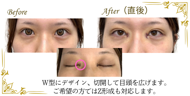 目頭切開のW形成法デザイン