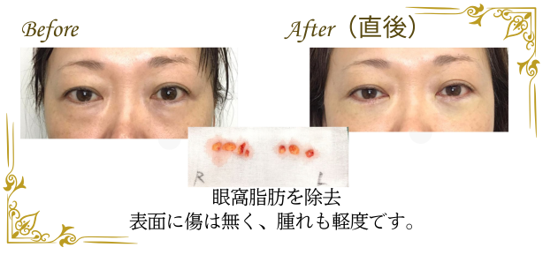 経結膜脱脂　クマ取り　のビフォーアフター