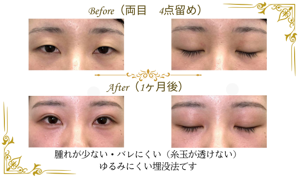 二重整形（埋没法）の術前と1ケ月後