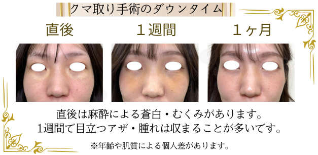 クマ取り（経結膜脱脂）のダウンタイムと時間経過