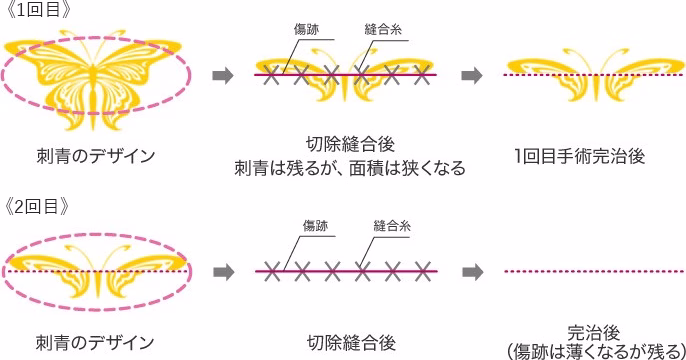 大きなタトゥーの分割切除　イメージ