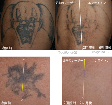 タトゥー 刺青除去 ピコレーザー 手術治療 東郷美容形成外科 福岡 福岡 博多駅前で美容外科 美容整形なら