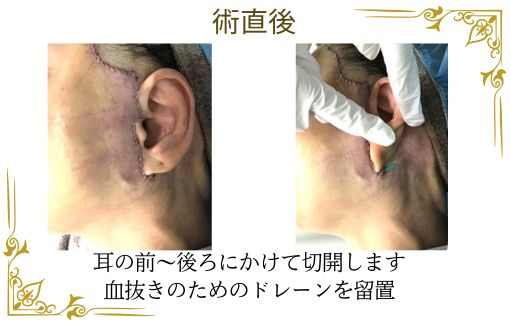 フェイスリフトのデザインと術直後の様子