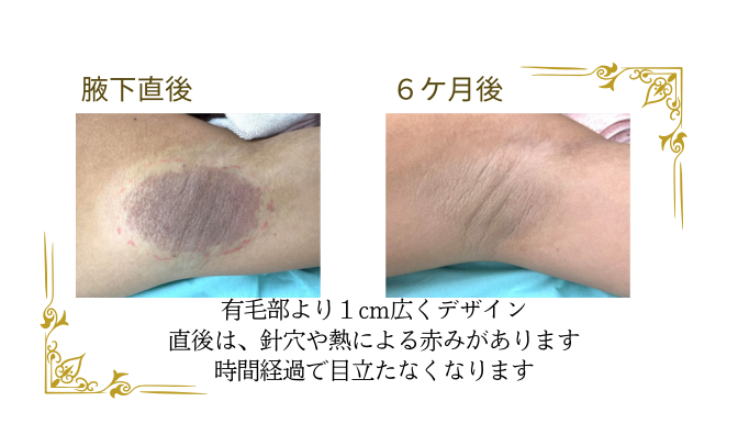 切らないワキガ治療　福岡のおすすめクリニック