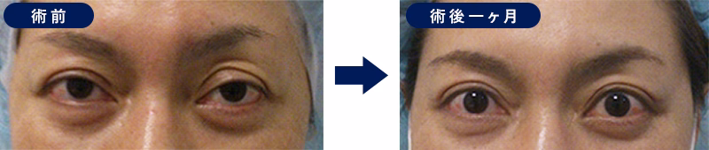 眼瞼下垂 手術前後の比較