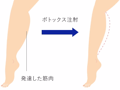 ふくらはぎボトックスで脚やせ効果