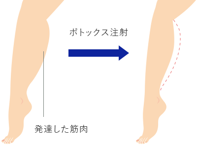 ふくらはぎ 脚やせ ボトックス 東郷美容形成外科 福岡 福岡 博多駅前で美容外科 美容整形なら