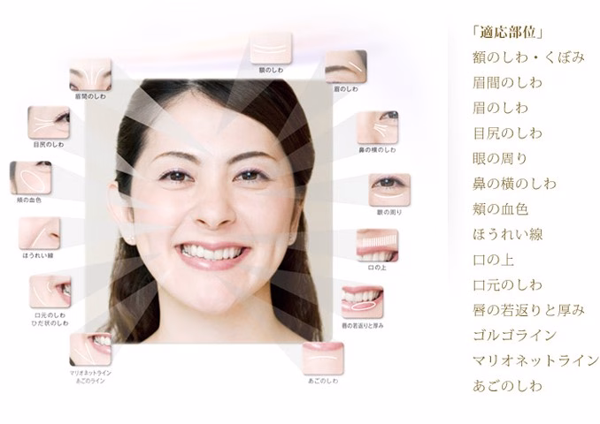 ボトックスの適応