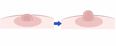 陥没乳頭 手術イメージ