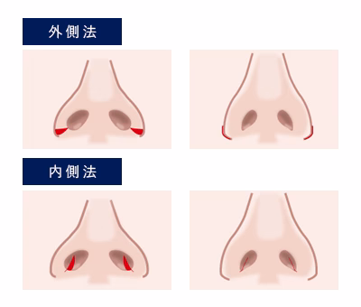 小鼻縮小 手術方法の違い