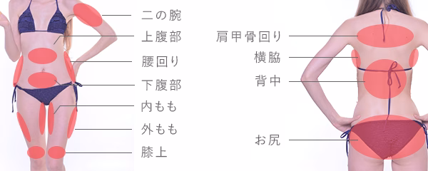 脂肪溶解注射 ボディへの適応