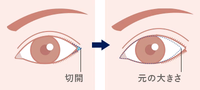 目尻切開で目を大きく見せる