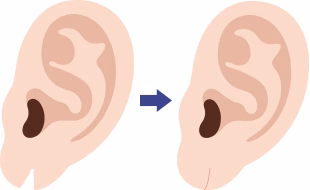 切れ耳・ピアス穴閉じのイメージ