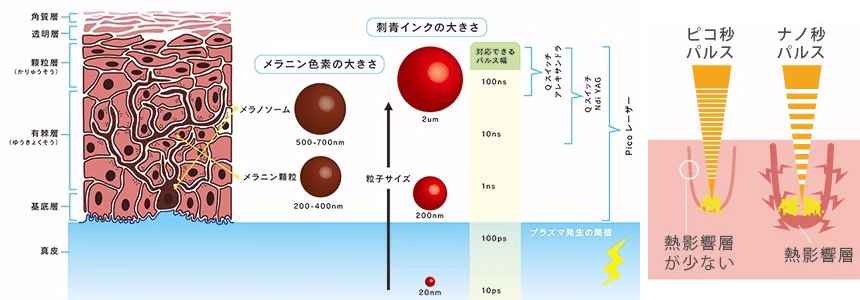 ピコレーザーによるタトゥー除去の仕組み