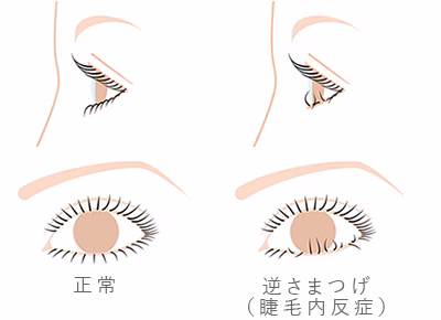 逆さまつ毛のイメージ