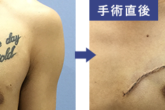 福岡で刺青・タトゥーの切除手術をお考えの方に　　よくあるご質問
