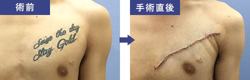 タトゥー切除　症例