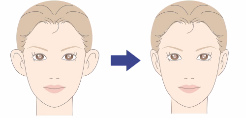 立ち耳を寝かせる手術