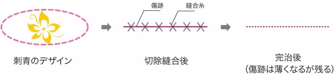 タトゥー切除手術　イメージ