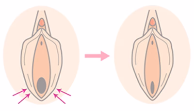 膣縮小手術　イメージ