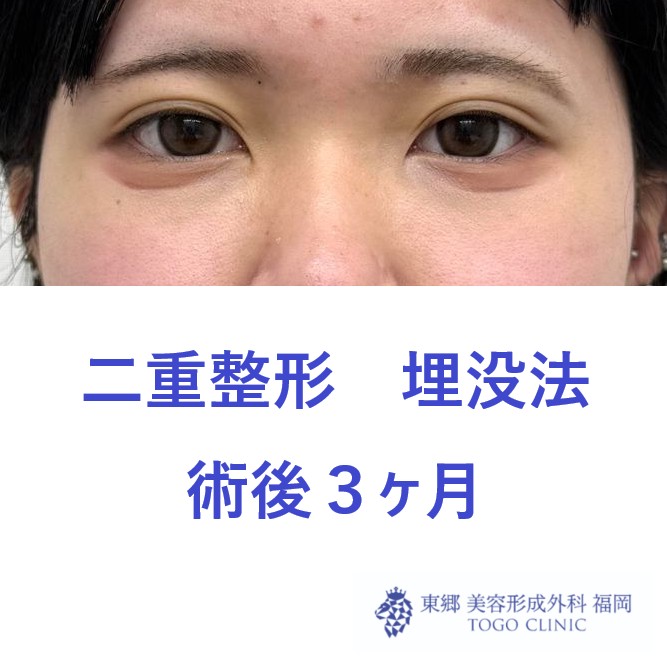 NY　術後３M - コピー