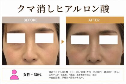 福岡・博多で目の下クマヒアルロン酸