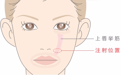 ガミースマイル　ボトックス注射部位