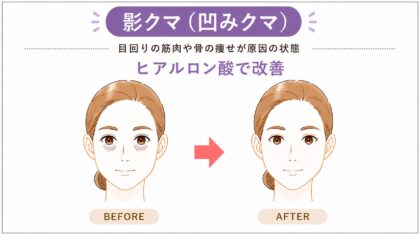 福岡・目の下のヒアルロン酸注入