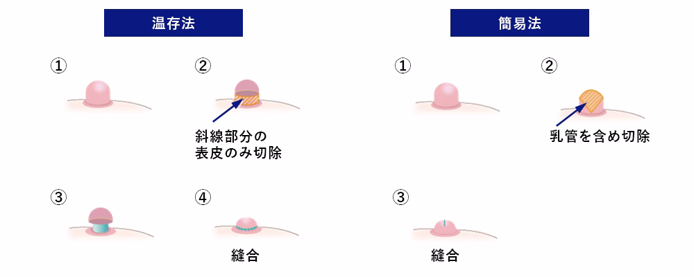 乳頭縮小 術式のイメージ