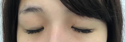 術前閉瞼