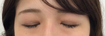 術後閉瞼