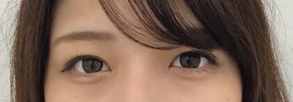 術後正面
