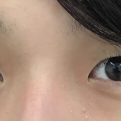術前 正面