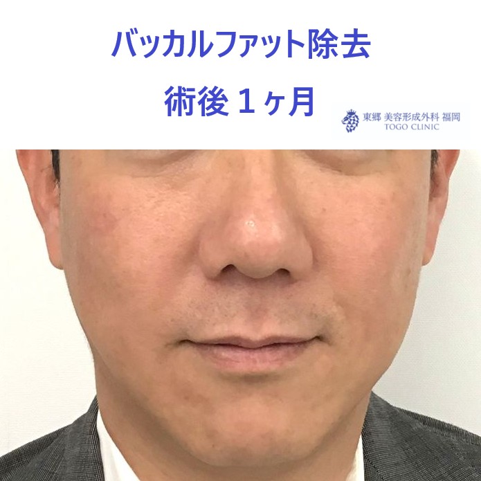 後51ヒロセカツシ　バッカルファット　術後正面_R