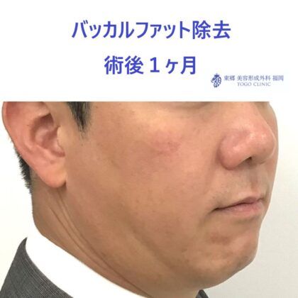 51ヒロセカツシ　バッカルファット　術後ななめ_R