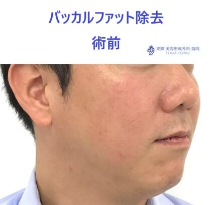51ヒロセカツシ　バッカルファット　術前ななめ_R