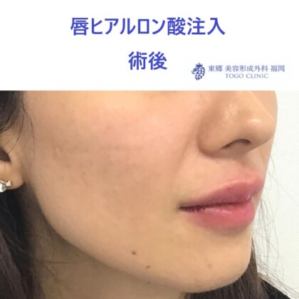 20レティシアミヤノハラ唇HA術後斜め